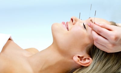 acupuncture-happiness-healing