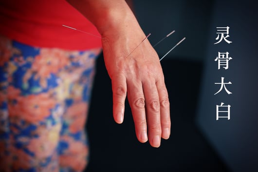 Acupuncture on the hand
