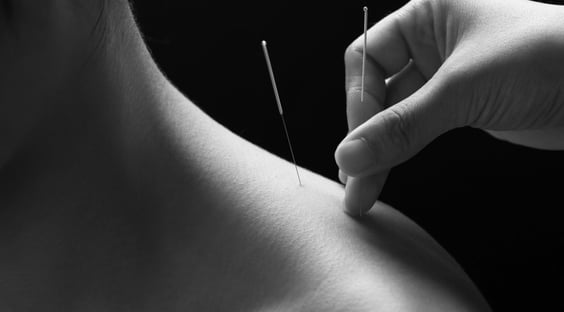 acupuncture-bw-1.jpg