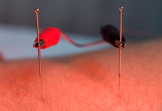 Electroacupuncture Dual-Needles