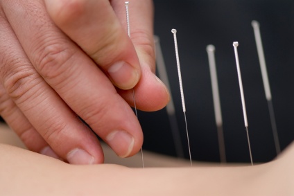 acupuncture-needle
